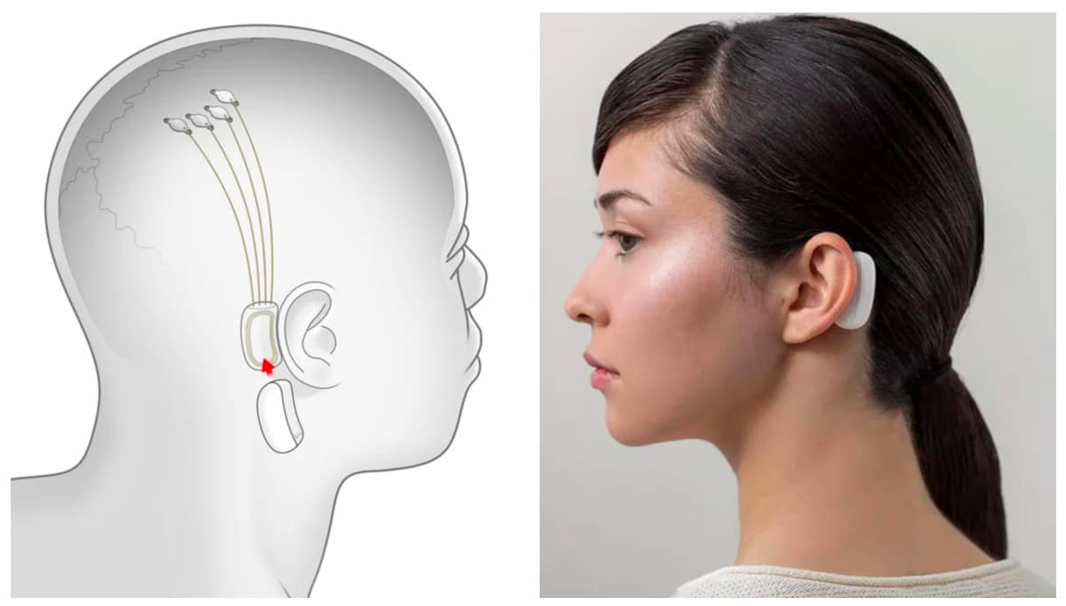 Neuralink sera prêt pour les implants humains en 2022
