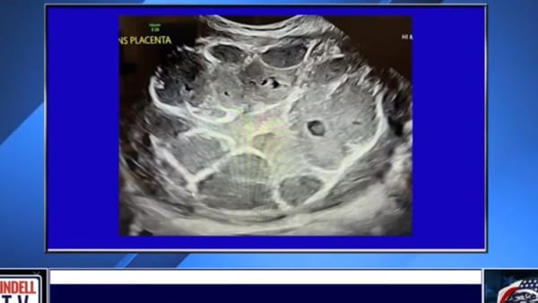 Naomi Wolf partage une image « effrayante » du placenta d’une femme enceinte après la vaccination contre le Covid