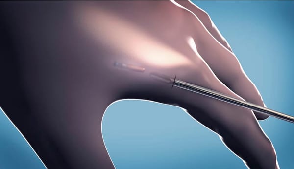 Puce sous la peau : hier du « complot », aujourd’hui sur France Info…